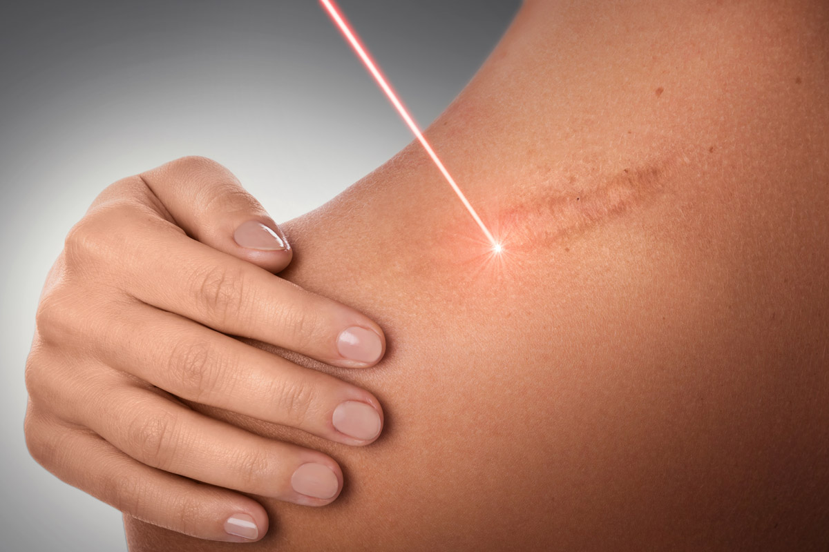 Does Cold Laser Therapy Help With Older Scars?