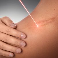 Does Cold Laser Therapy Help With Older Scars?